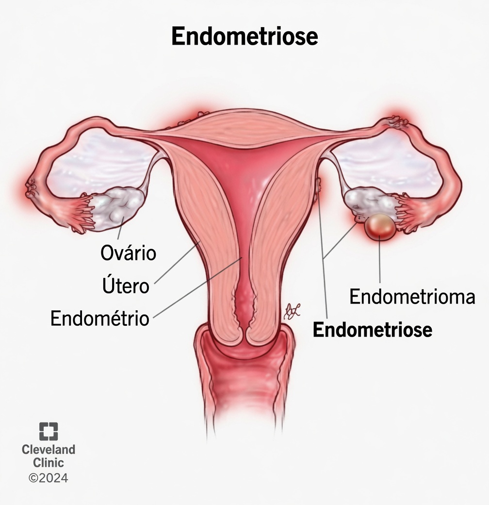 O que é a endometriose e por que toda mulher deveria saber sobre ela?