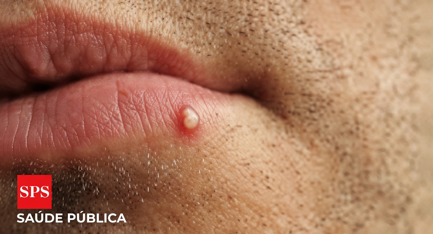 Por Que as Pessoas Notam Pequenas Protuberâncias Brancas Incomuns nos Lábios ou nas Partes Íntimas: Um Guia Simples