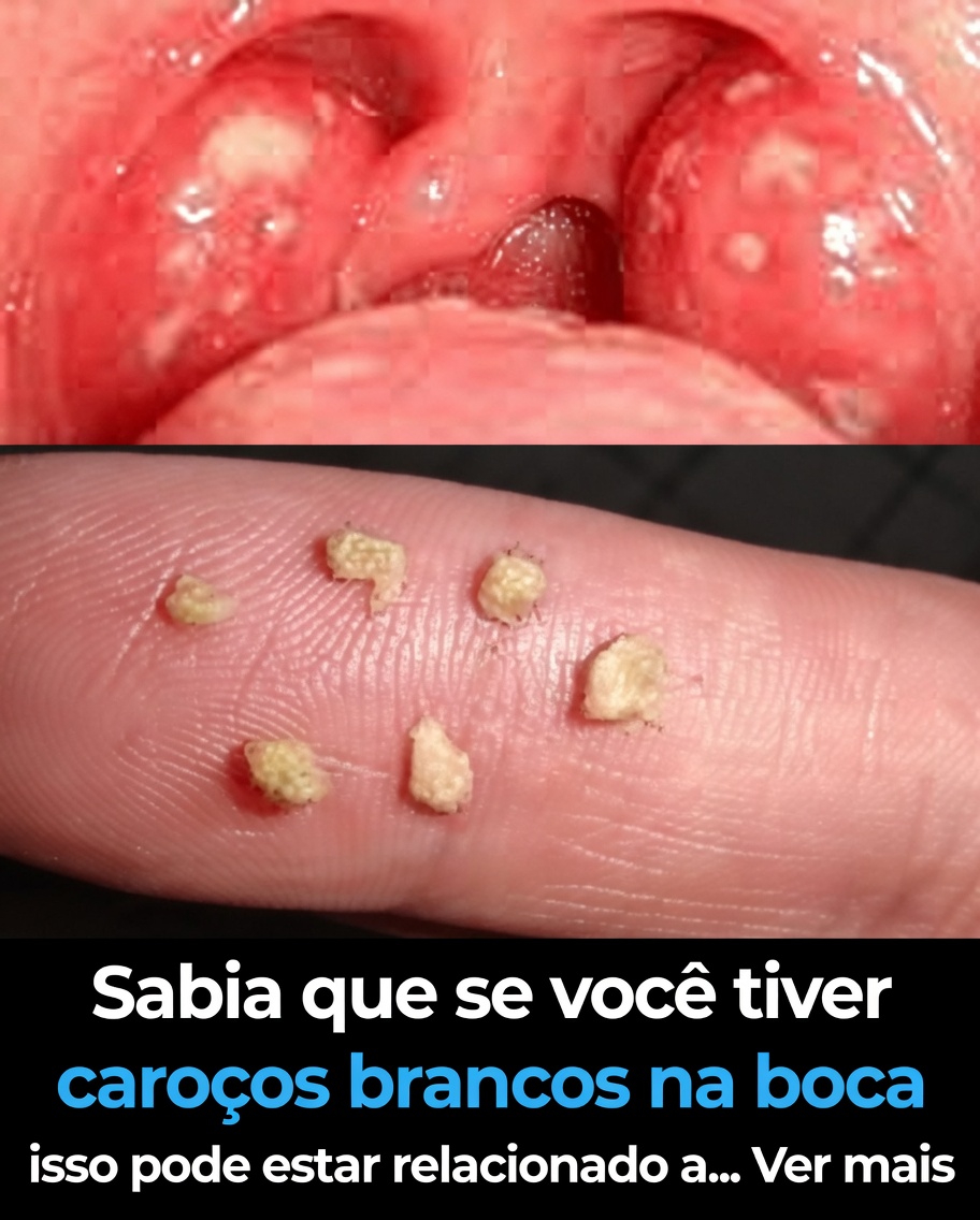 Descubra o que aquelas bolinhas brancas na sua boca podem significar e hábitos diários que valem a pena experimentar