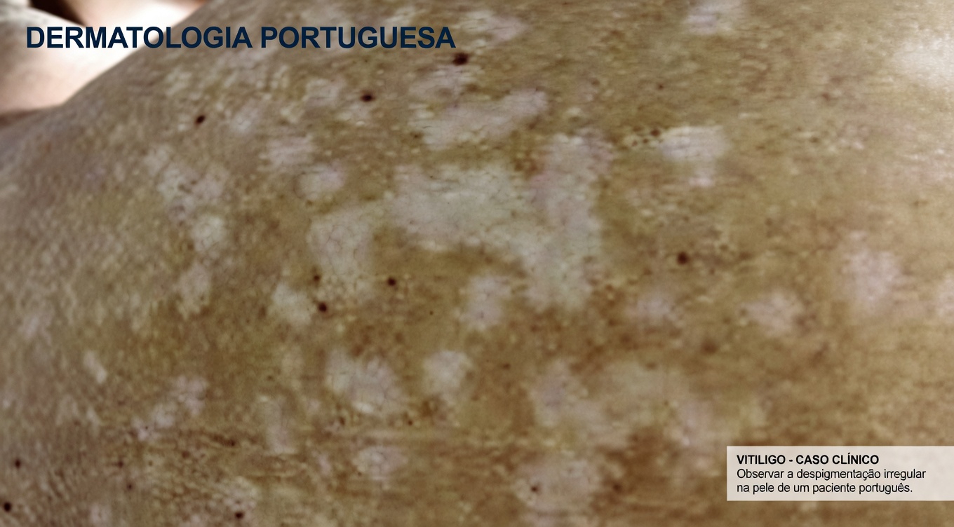 Por que pequenas manchas brancas aparecem nos seus braços e pernas? Entendendo as alterações comuns da pele