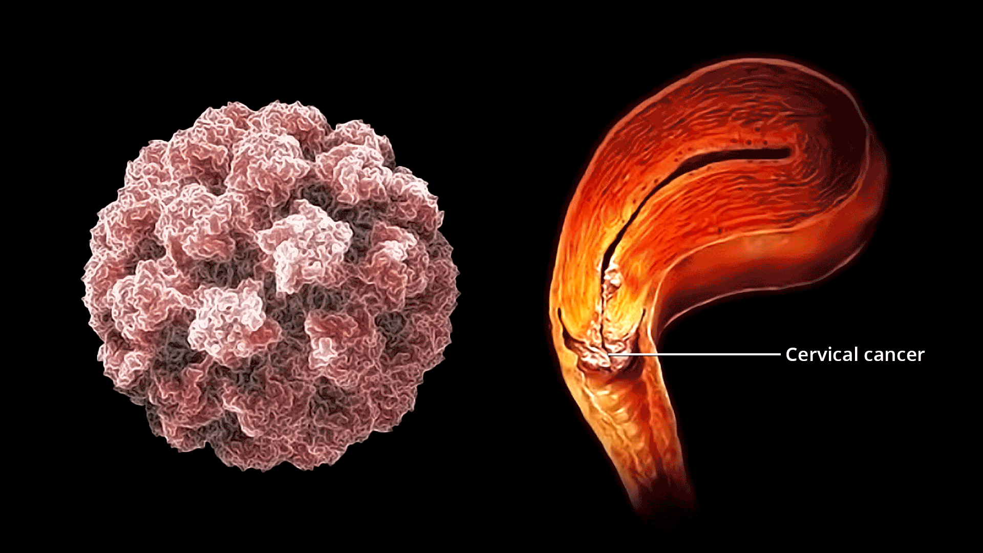 Os Sintomas Críticos do Câncer de Colo do Útero que Toda Mulher Precisa Conhecer e Nunca Ignorar