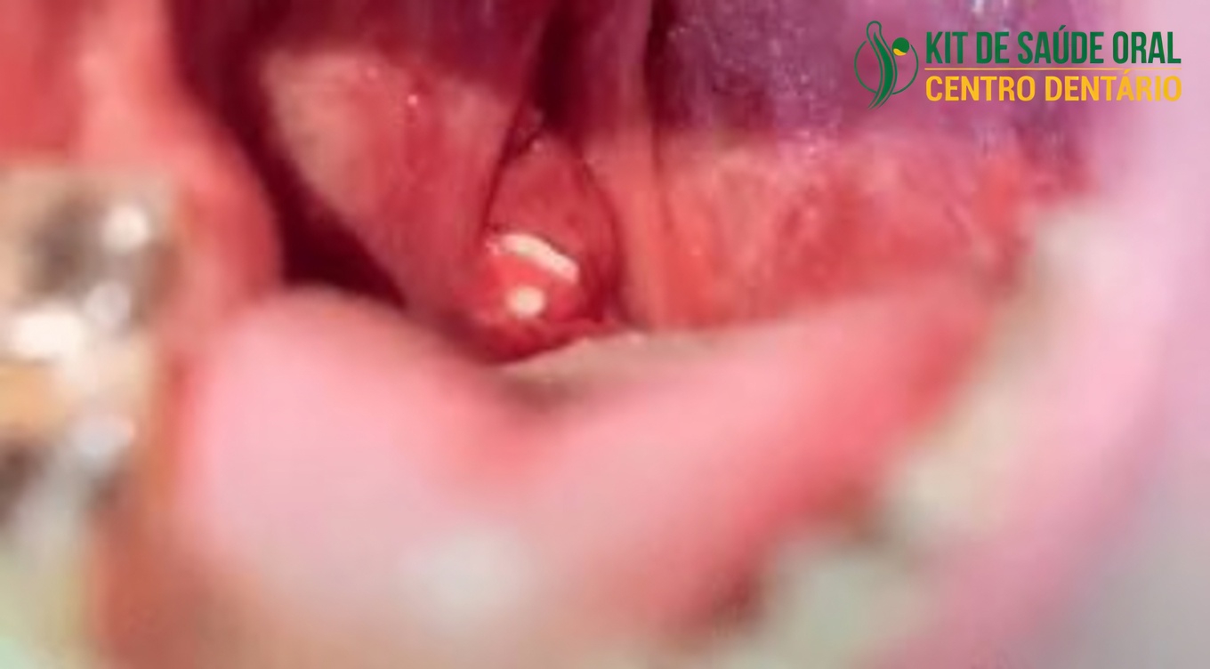 Cáseos amigdalianos: o que são e por que podem estar por trás do seu mau hálito persistente