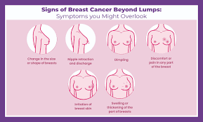 Sintomas do câncer de mama além do nódulo: sinais menos conhecidos que toda mulher deve reconhecer