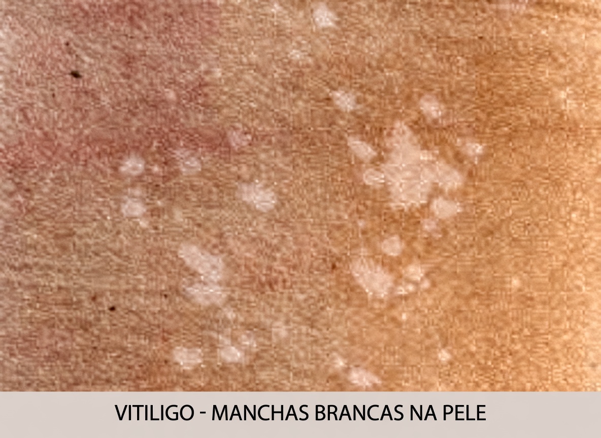 O que são essas pequenas manchas brancas na pele?