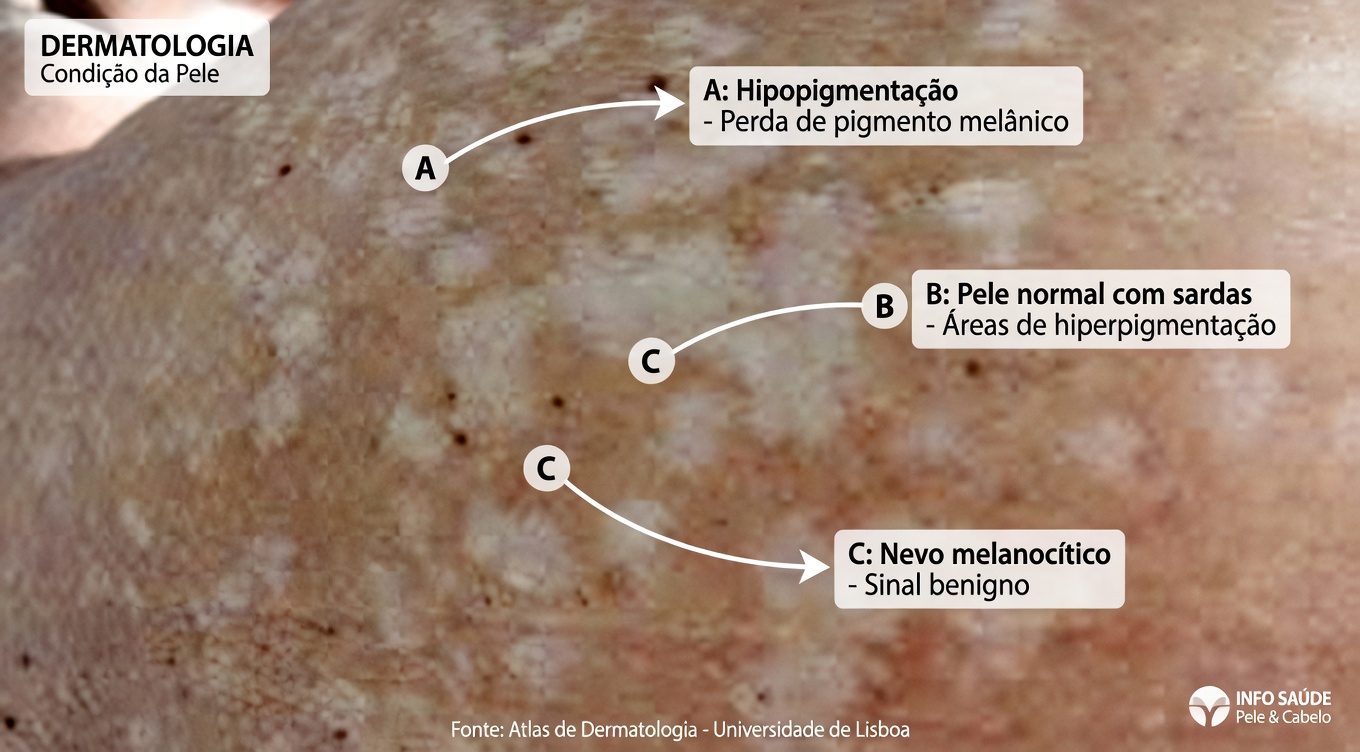Aquelas pequenas manchas brancas nos seus braços, pernas e costas: o que você precisa saber sobre essa alteração comum da pele