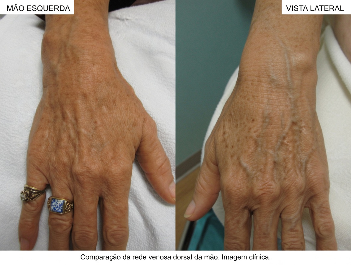 10 Maneiras Naturais de Eliminar as Varizes e Melhorar a Circulação Sanguínea Naturalmente