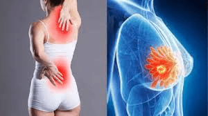 4 sinais precoces de câncer de mama que você nunca deve ignorar