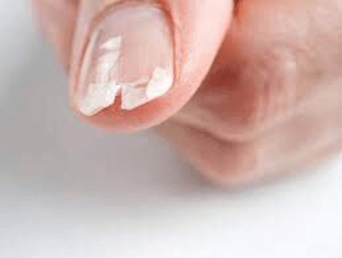Por que Minhas Unhas Continuam se Partindo ou Quebrando? 10 Razões Comuns e Maneiras Simples de Fortalecê-las