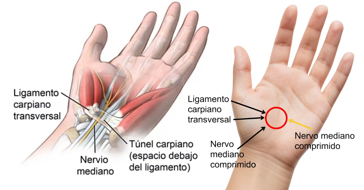 Alívio da síndrome do túnel do carpo: remédios naturais para o formigamento nas mãos