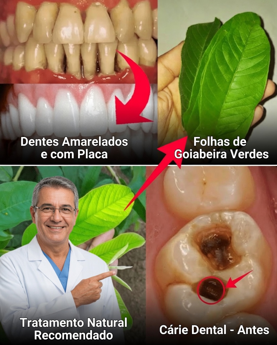 3 Maneiras Simples e Baratas de Tratar a Cárie Dentária com Folhas de Goiaba