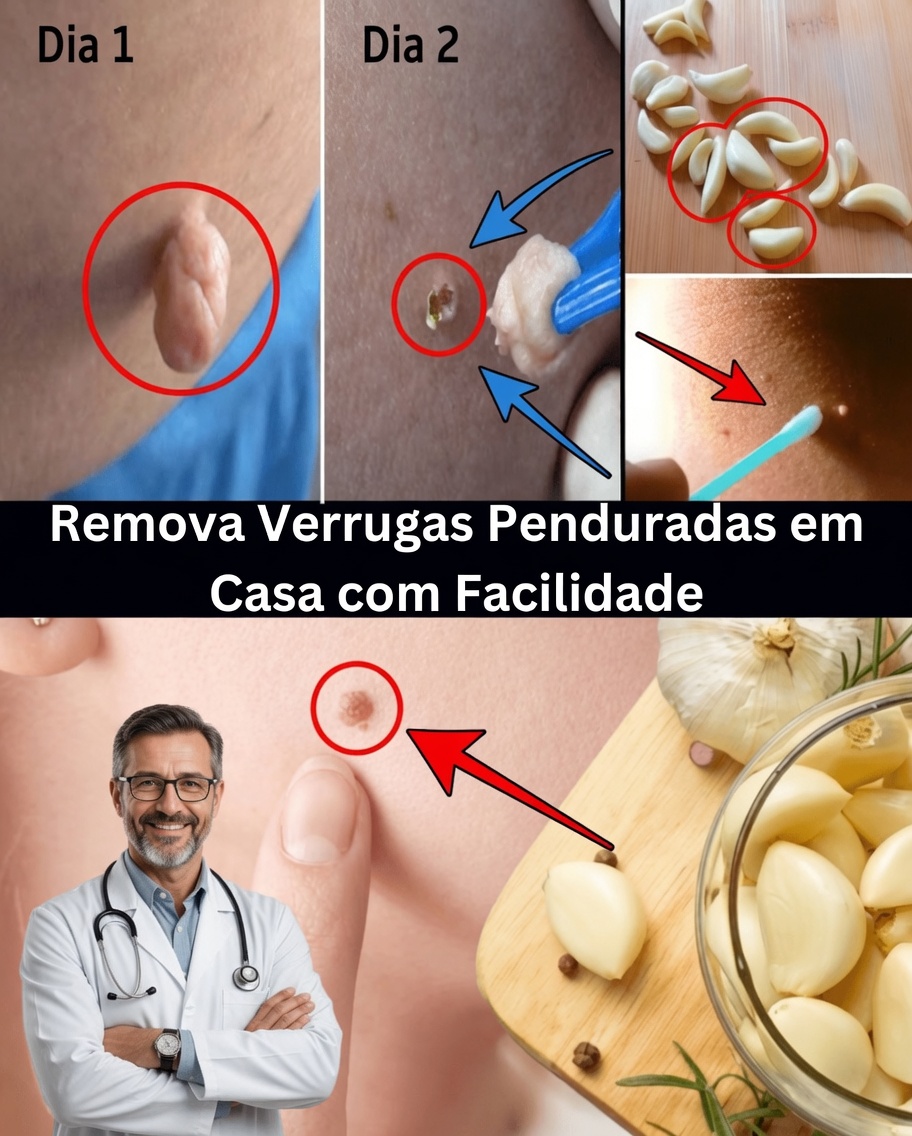 Como Remover Acrocórdons Naturalmente com Vaselina: Um Método Simples Durante a Noite