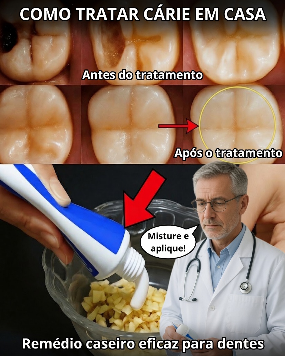 O que os dentistas raramente contam: dicas naturais que podem ajudar a prevenir cáries